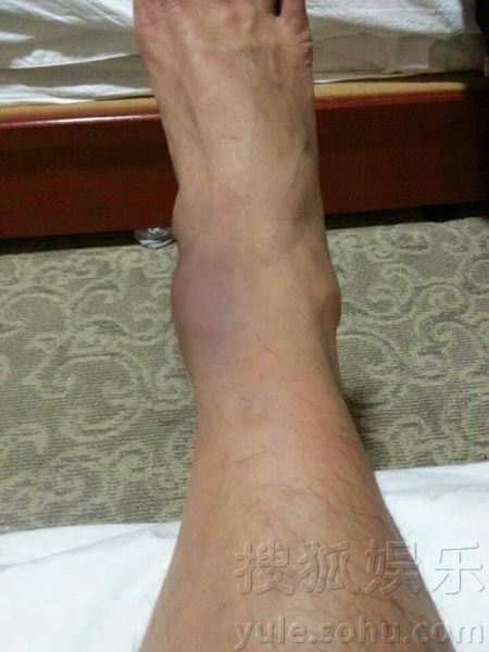 顾又铭拍武戏脚踝受伤 忍痛开工获赞"太拼命"