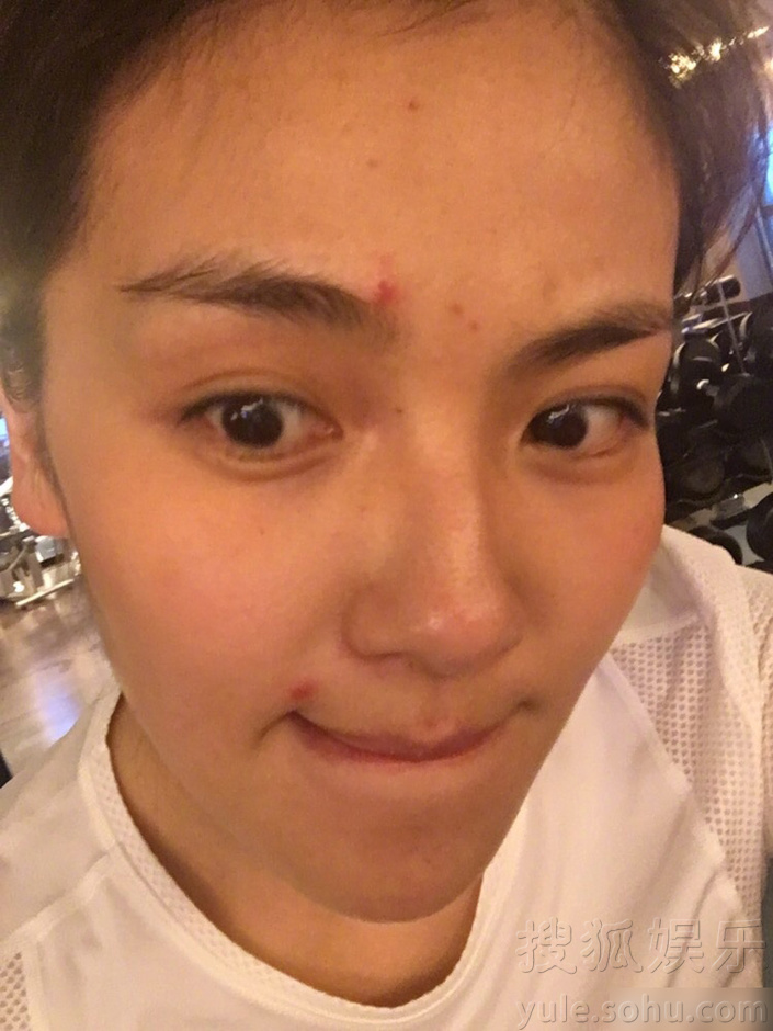 刘涛自曝素颜照 调侃自己长痘痘留痘印