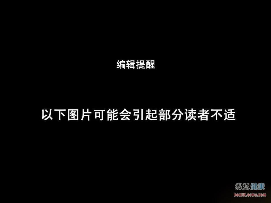 <em>男子</em>做包皮手术致<em>阴茎</em>被烤熟5202112-健康图