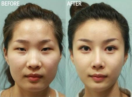 韩国惊人整容新案例 歪脸妹变美女